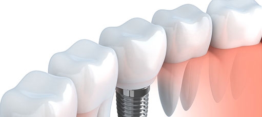 Immagine per Impianti dentali